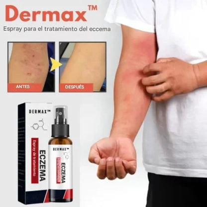 Psoriasis Treatment Spray 2X1