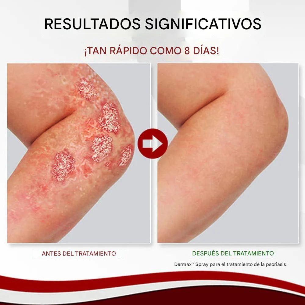 Psoriasis Treatment Spray 2X1