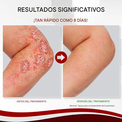 Psoriasis Treatment Spray 2X1