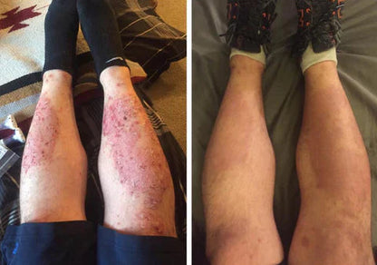 Psoriasis Treatment Spray 2X1