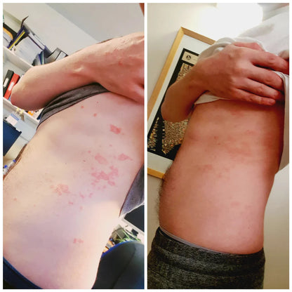 Psoriasis Treatment Spray 2X1