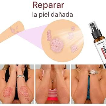 Psoriasis Treatment Spray 2X1